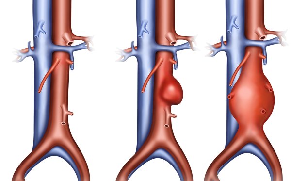 Aneurisma dell'aorta toracica